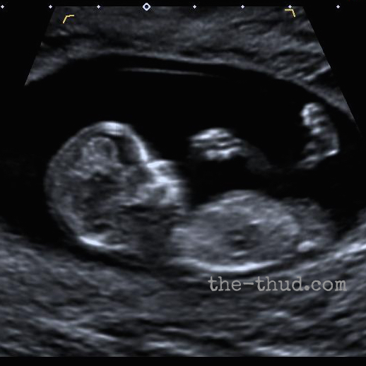 First trimester scan - 12 weeks